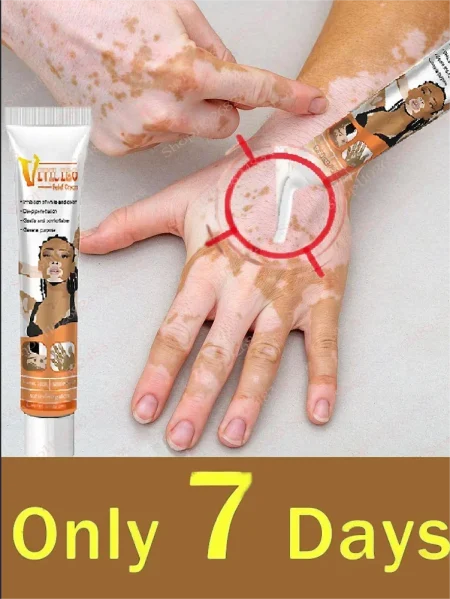 Vitiligo cream, men's and women's skin care essence