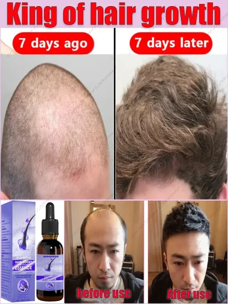 Fast Hair Growth Essence Effective Anti Hair Loss Serum Baldness Repair Hereditary Postpartum Seborrheic Hair Loss Care