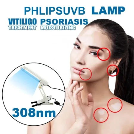 Uvb 308nm Narrow Band Ultraviolet Lamps Household Phototherapy Treatment Anti-White Spot Treat Vitiligo Psoriasis